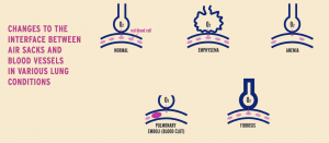 Infographic that shows how lung diseases affect your alveoli. Diffusing capacity tests tell your doctor if your alveoli have been damaged.