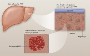 The liver with inset images showing clusters of AAT and polymerized AAT molecules typical in Alpha-1 liver disease.